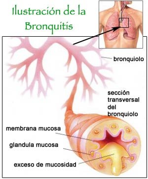 ABORDAJE DE LA BRONQUITIS Y BRONQUIOLITIS AGUDA CON HOMEOPATÍA