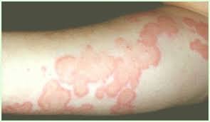 URTICARIA Y HOMEOPATÍA