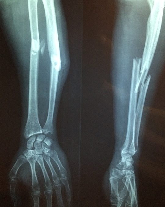 FRACTURAS