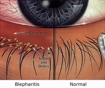 BLEFARITIS